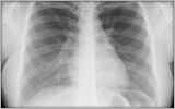 Idiopatická plicní fibróza a kouření